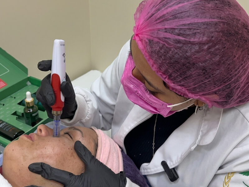 Sessão de microagulhamento facial para renovação cutânea