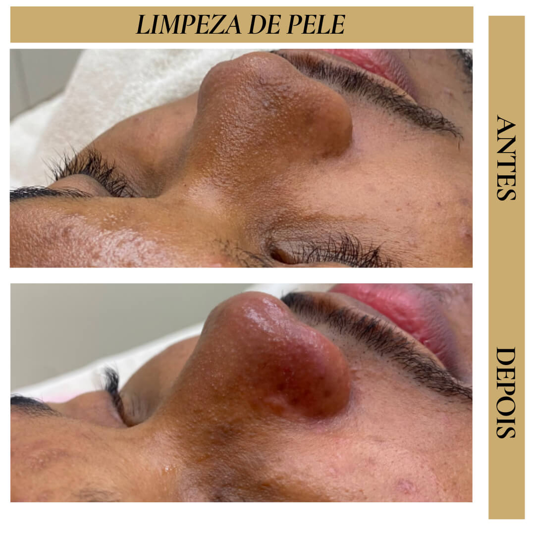 Antes e Depois - Limpeza de Pele