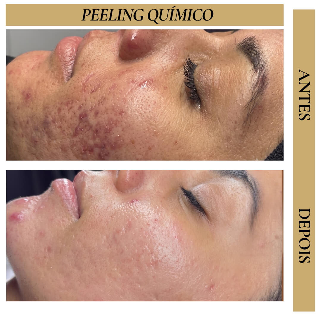 Antes e Depois - Peeling Químico