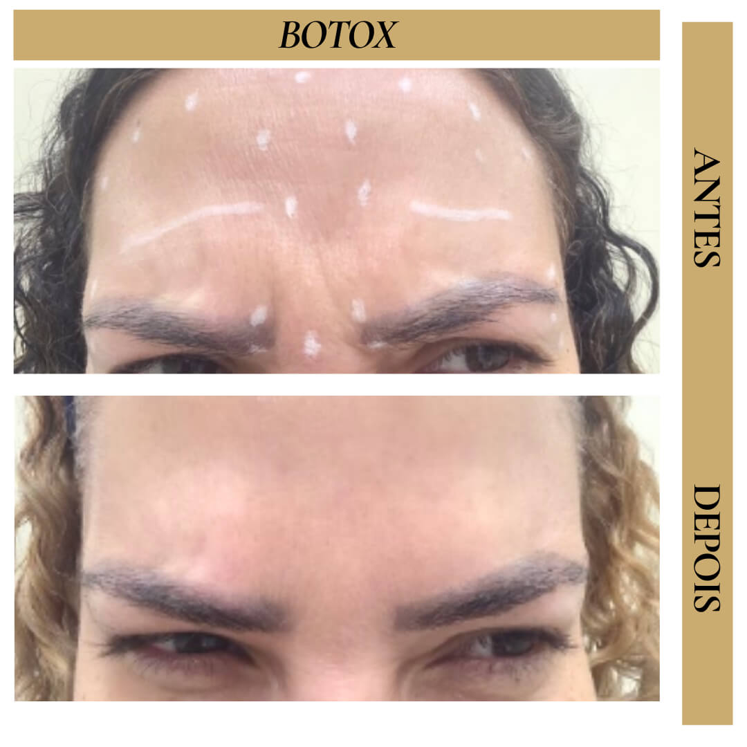 Antes e Depois - Toxina Botulínica