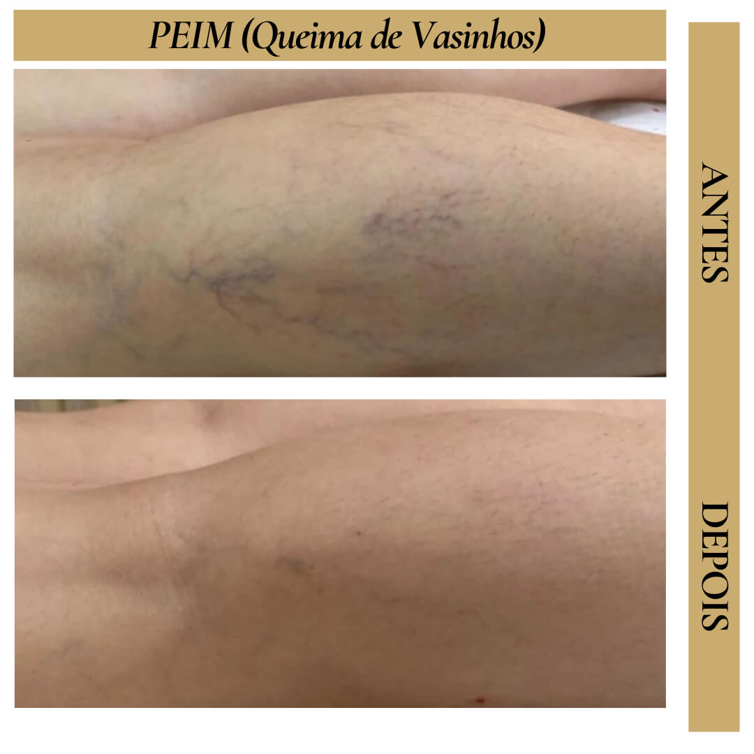 Antes e Depois - PEIM(Queima-De-Vasinhos)