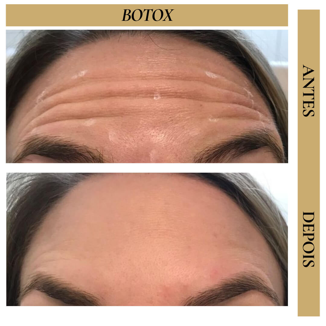 Antes e Depois - Toxina Botulínica Facial